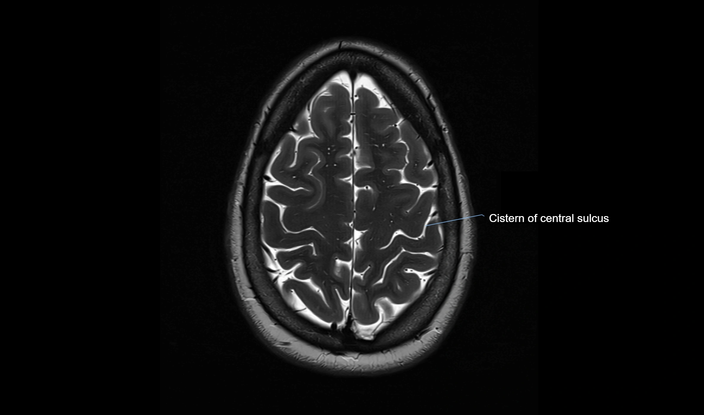 Brain cisterns  and ventricles  axial anatomy 3T MRI image-img-00001-00048.webp